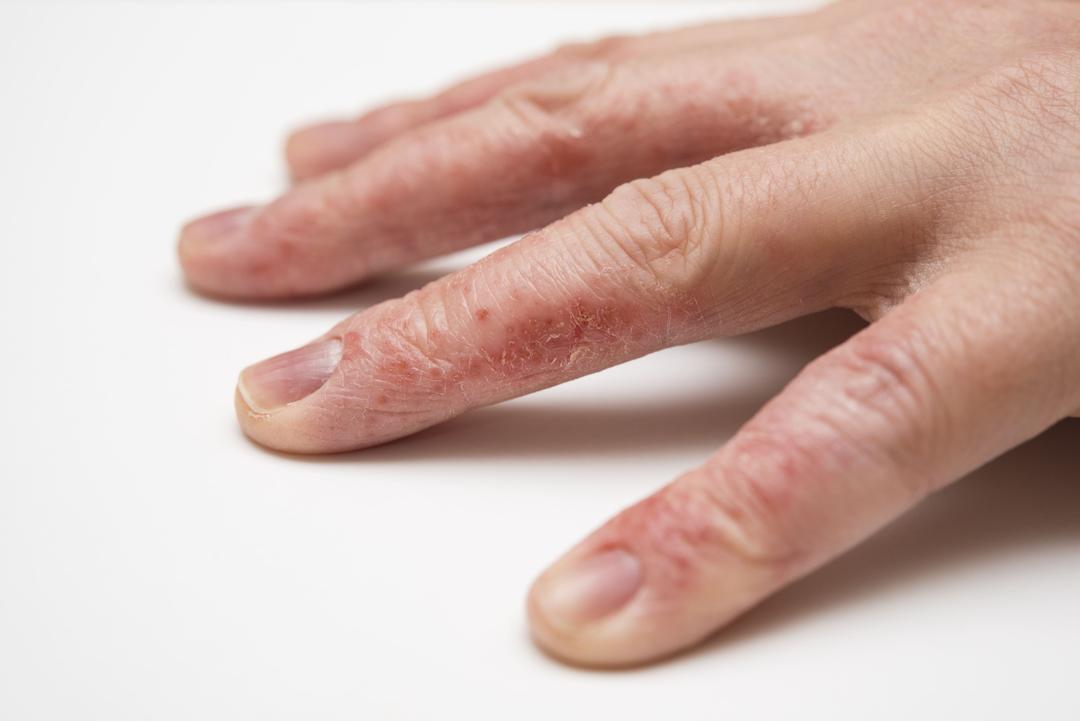 Eczema/atopic dermatitis treatment