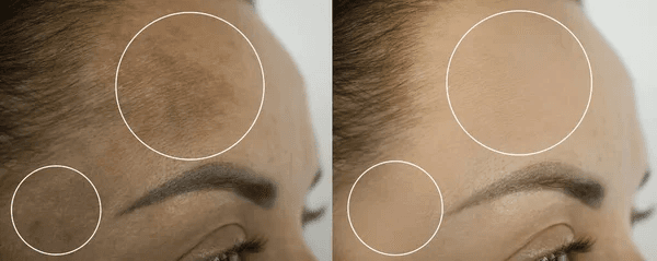 Melasma