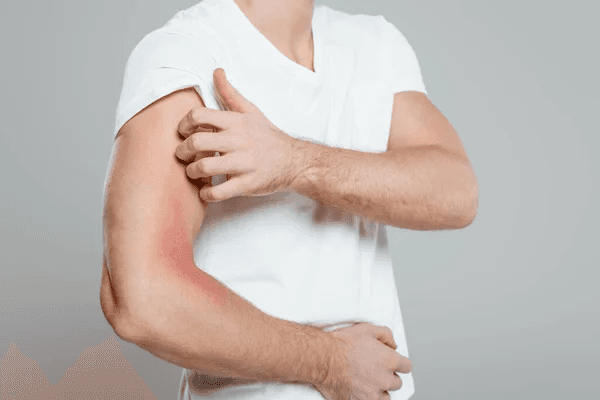 Eczema Dermatologist