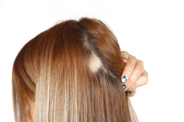 Alopecia