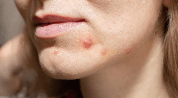Blood Pimple on the Face